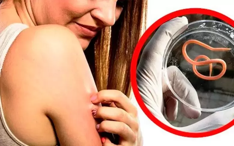 mâncărime și iritații din cauza paraziților din organism