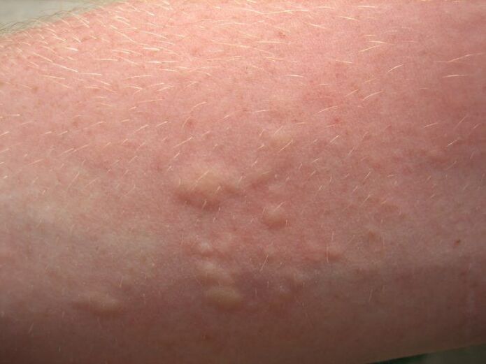 erupțiile cutanate alergice cu mâncărime pot fi simptome ale ascariazei