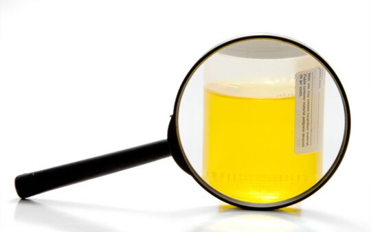 Examinarea urinei pentru a diagnostica schistosomiaza